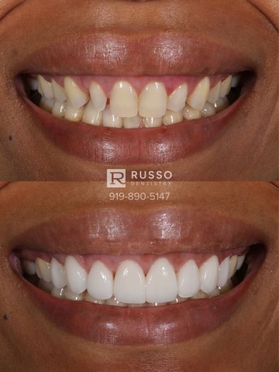Smile Cases Russo DDS Before After White Teeth Veneers Implants Before After Cosmetic Dentistry