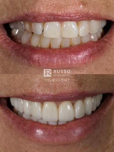 Smile Cases Russo DDS Before After White Teeth Veneers Implants Before After Cosmetic Dentistry