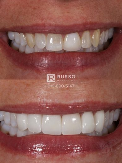 Smile Cases Russo DDS Before After White Teeth Veneers Implants Before After Cosmetic Dentistry