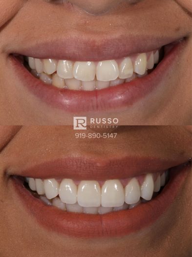 Smile Cases Russo DDS Before After White Teeth Veneers Implants Before After Cosmetic Dentistry