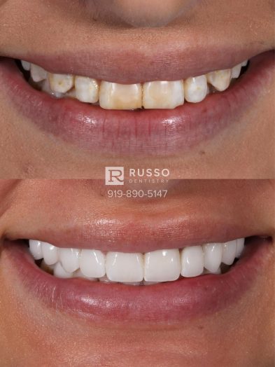 Smile Cases Russo DDS Before After White Teeth Veneers Implants Before After Cosmetic Dentistry