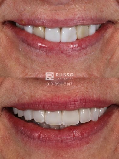 Smile Cases Russo DDS Before After White Teeth Veneers Implants Before After Cosmetic Dentistry