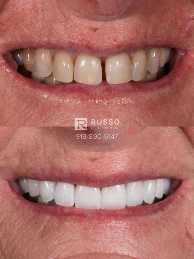 Smile Cases Russo DDS Before After White Teeth Veneers Implants Before After Cosmetic Dentistry