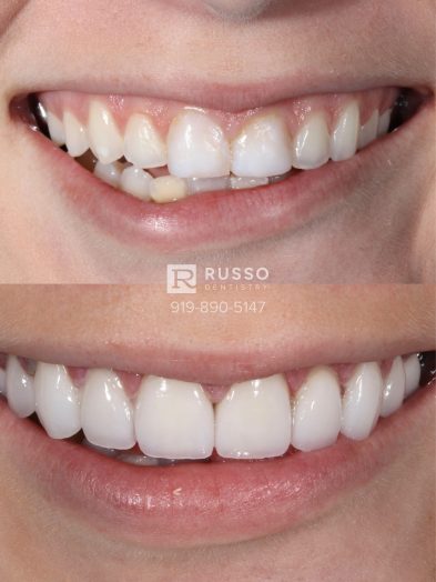 Smile Cases Russo DDS Before After White Teeth Veneers Implants Before After Cosmetic Dentistry