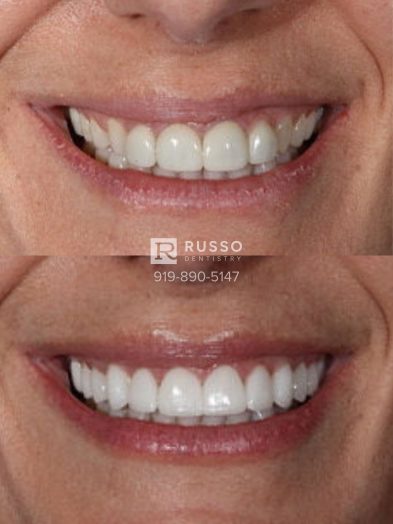 Smile Cases Russo DDS Before After White Teeth Veneers Implants Before After Cosmetic Dentistry