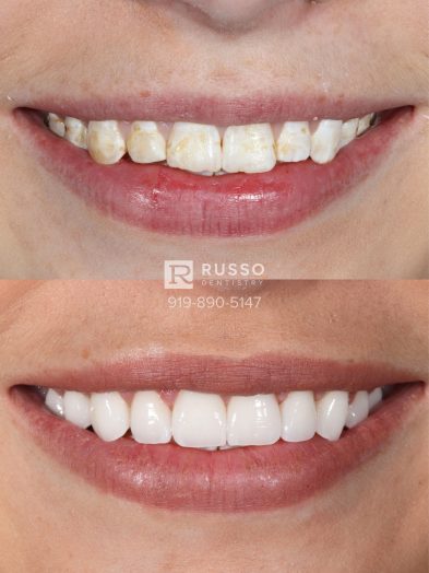 Smile Cases Russo DDS Before After White Teeth Veneers Implants Before After Cosmetic Dentistry