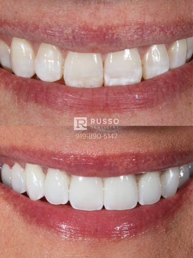 Smile Cases Russo DDS Before After White Teeth Veneers Implants Before After Cosmetic Dentistry