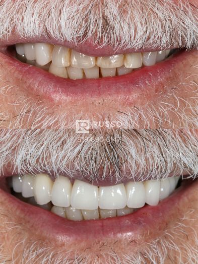 Smile Cases Russo DDS Before After White Teeth Veneers Implants Before After Cosmetic Dentistry