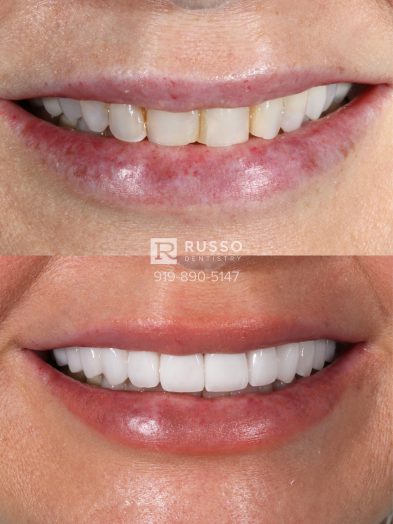 Smile Cases Russo DDS Before After White Teeth Veneers Implants Before After Cosmetic Dentistry