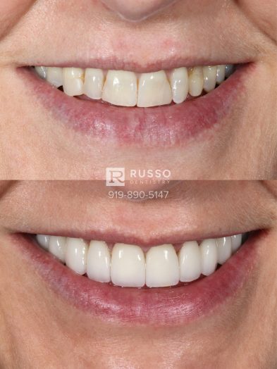 Smile Cases Russo DDS Before After White Teeth Veneers Implants Before After Cosmetic Dentistry