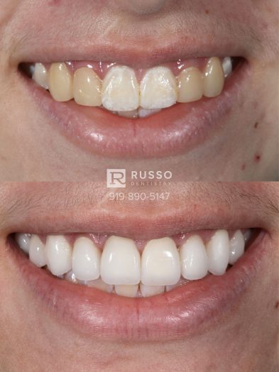 Smile Cases Russo DDS Before After White Teeth Veneers Implants Before After Cosmetic Dentistry
