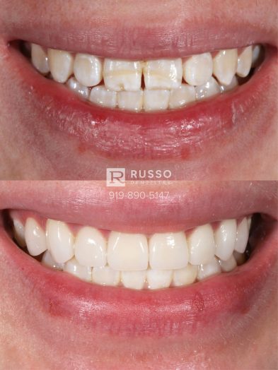 Smile Cases Russo DDS Before After White Teeth Veneers Implants Before After Cosmetic Dentistry