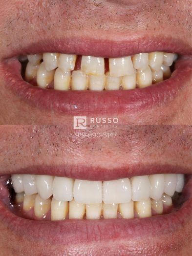 Smile Cases Russo DDS Before After White Teeth Veneers Implants Before After Cosmetic Dentistry