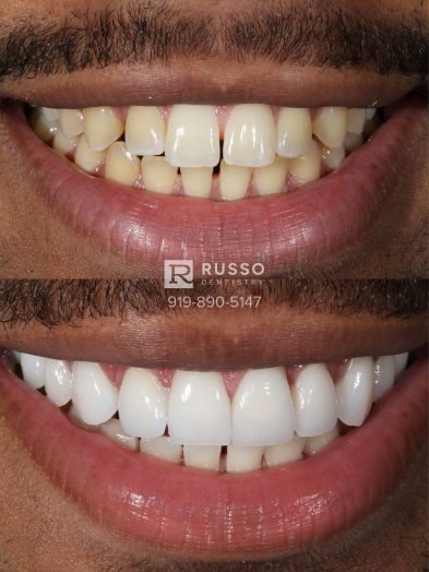 Smile Cases Russo DDS Before After White Teeth Veneers Implants Before After Cosmetic Dentistry