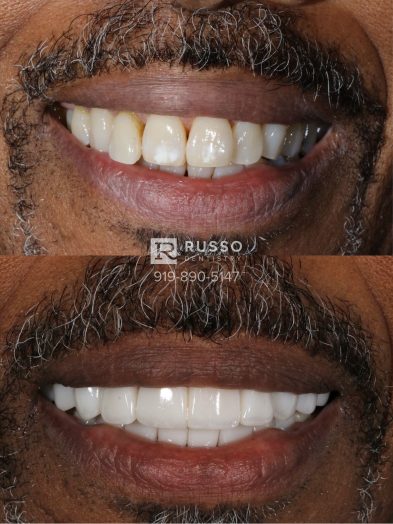 Smile Cases Russo DDS Before After White Teeth Veneers Implants Before After Cosmetic Dentistry