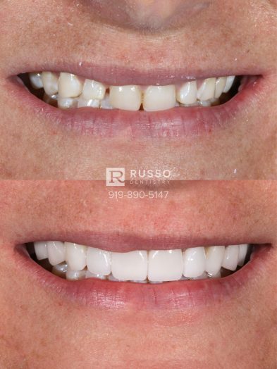 Smile Cases Russo DDS Before After White Teeth Veneers Implants Before After Cosmetic Dentistry