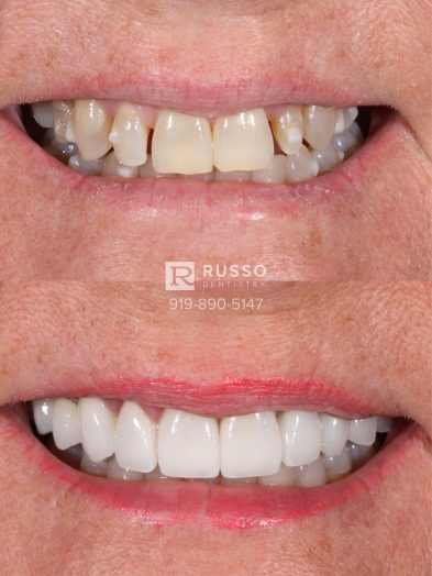 Smile Cases Russo DDS Before After White Teeth Veneers Implants Before After Cosmetic Dentistry