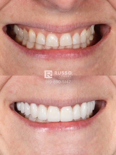 Smile Cases Russo DDS Before After White Teeth Veneers Implants Before After Cosmetic Dentistry