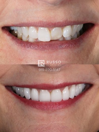 Smile Cases Russo DDS Before After White Teeth Veneers Implants Before After Cosmetic Dentistry