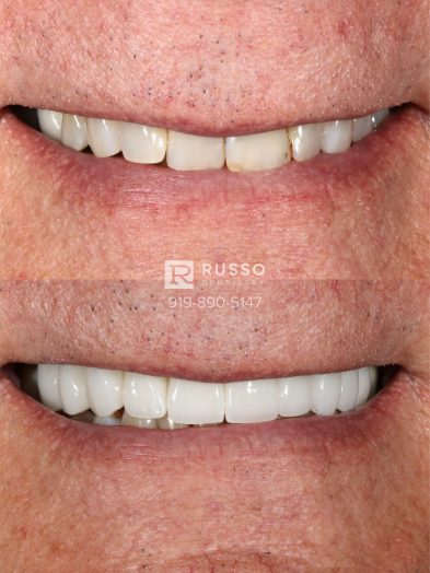 Smile Cases Russo DDS Before After White Teeth Veneers Implants Before After Cosmetic Dentistry