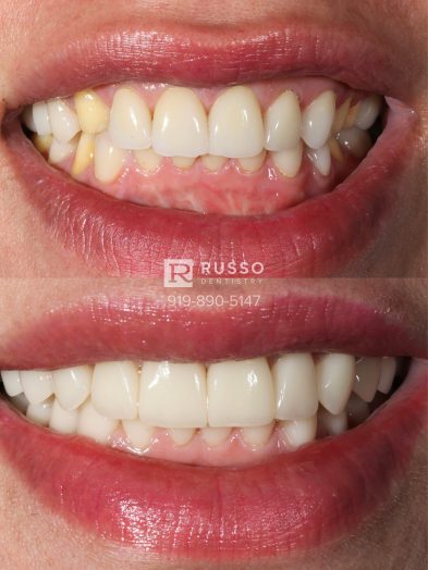 Smile Cases Russo DDS Before After White Teeth Veneers Implants Before After Cosmetic Dentistry