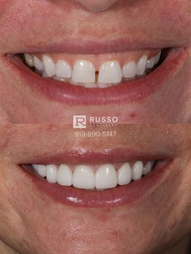 Smile Cases Russo DDS Before After White Teeth Veneers Implants Before After Cosmetic Dentistry