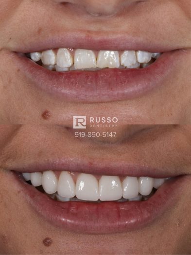 Smile Cases Russo DDS Before After White Teeth Veneers Implants Before After Cosmetic Dentistry