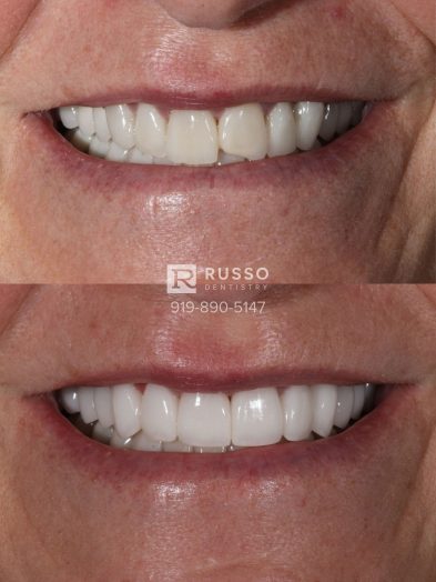 Smile Cases Russo DDS Before After White Teeth Veneers Implants Before After Cosmetic Dentistry